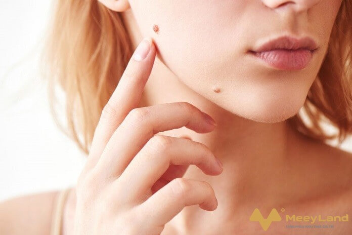 Vị trí nốt ruồi trên mặt nam và nữ nói lên điều gì?